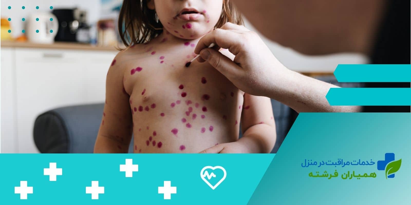 نحوه انتقال ویروس سرخک