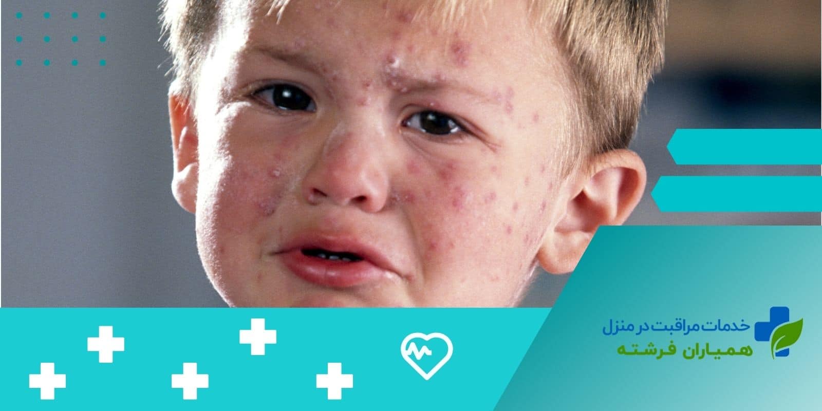  تشخیص آبله مرغان در کودکان