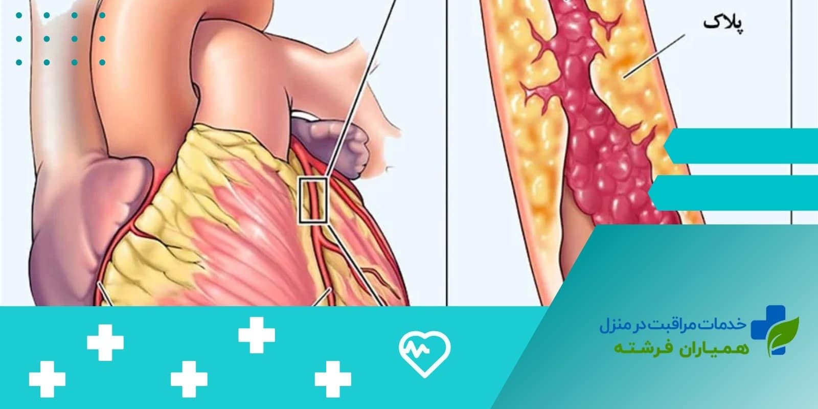  دلایل اصلی گرفتگی رگ‌ها