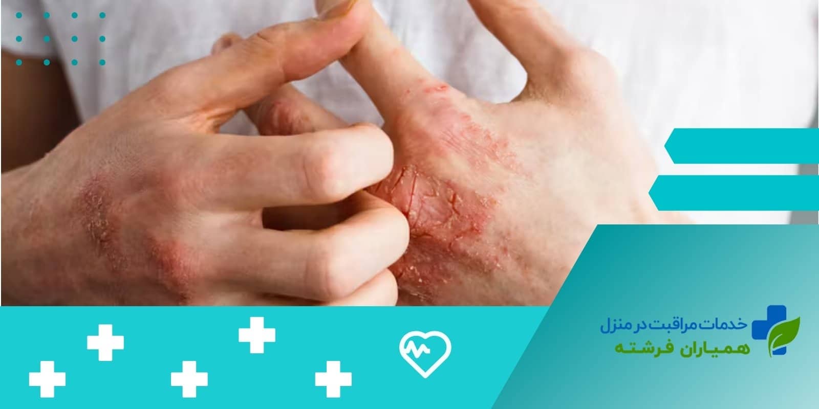 اگزما در سالمندان چیست؟علائم+تشخیص+انواع و درمان آن!