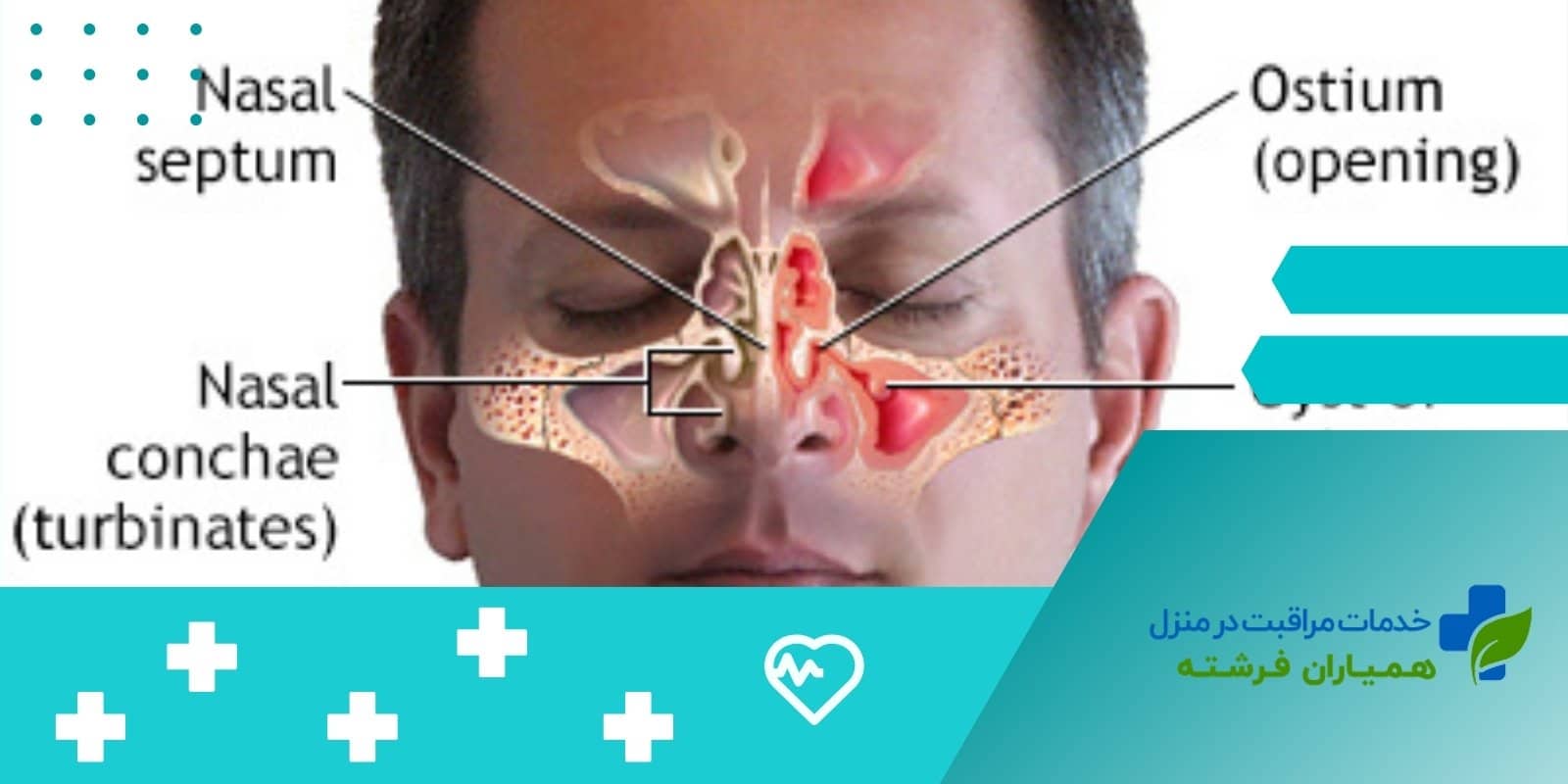 پیشگیری از سینوزیت در سالمندان