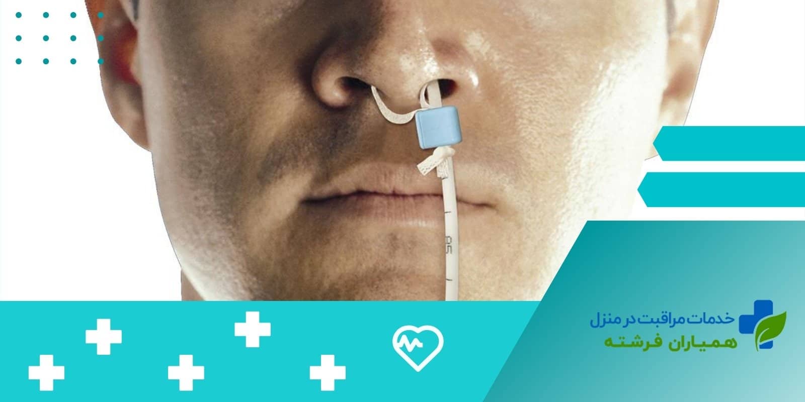 لوله تغذیه بینی به معده (NG Tube) معرفی+کاربردها+نکات مهم در استفاده از آن!
