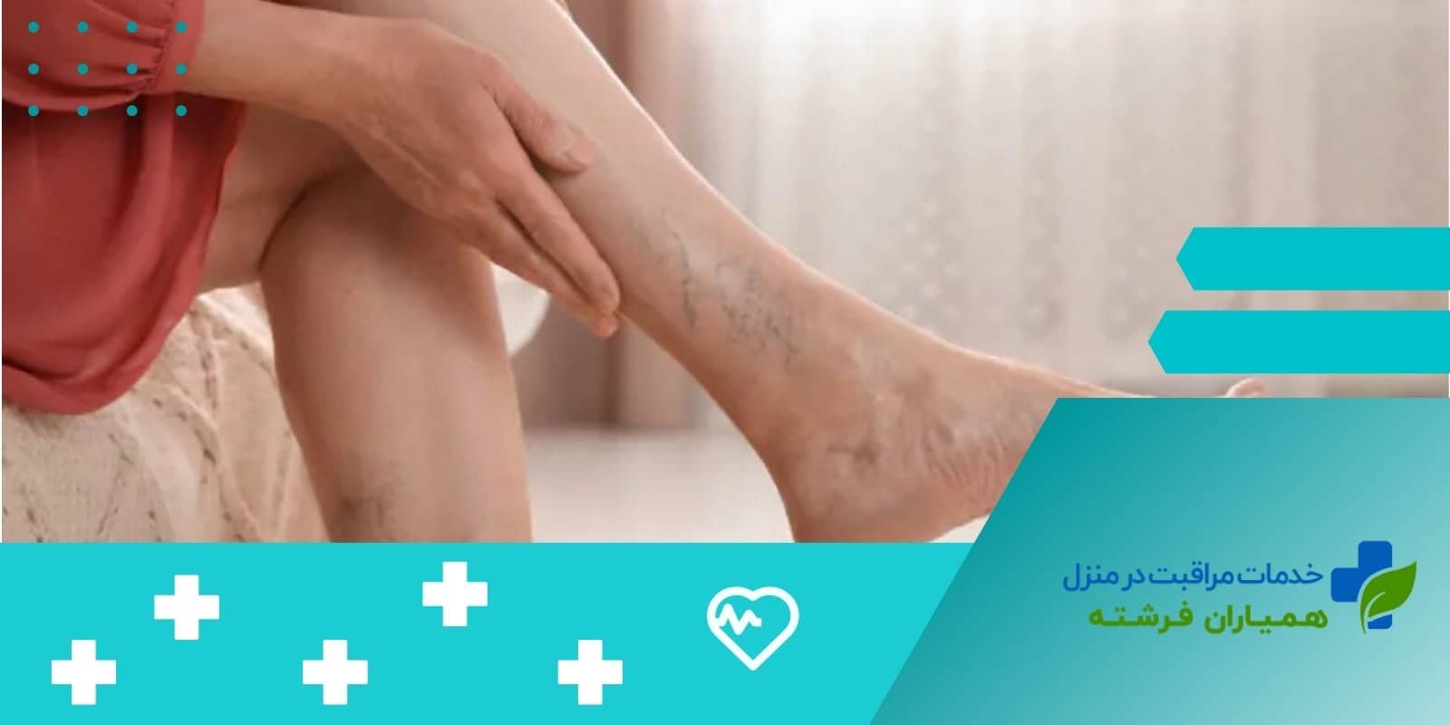 رگ‌های واریسی و روش‌های درمانی