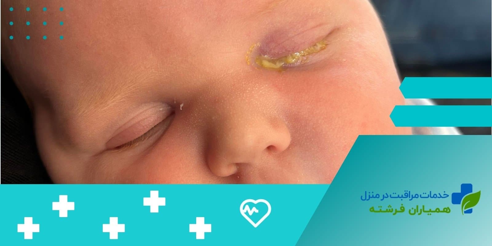 علت قی کردن چشم نوزاد و روش‌های درمان خانگی آن