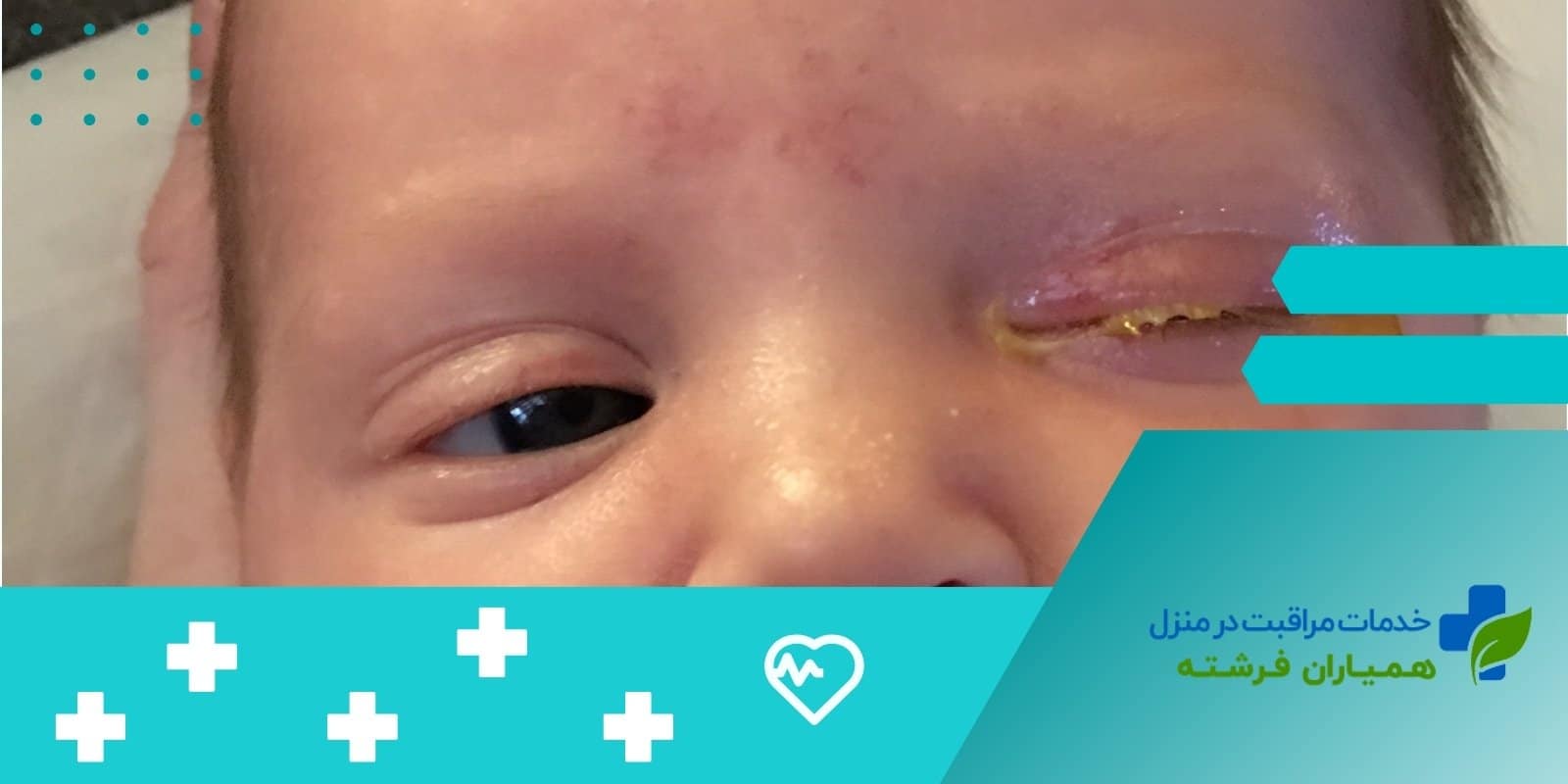 علت قی کردن چشم نوزاد